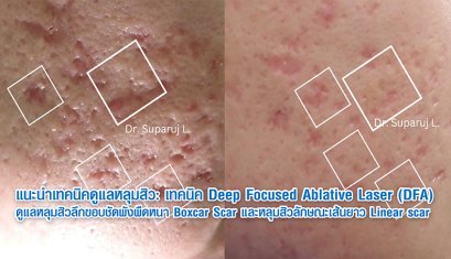 แนะนำเทคนิคดูแลหลุมสิว: เทคนิค Deep Focused Ablative Laser (DFA) ดูแลหลุมสิวลึกขอบชัดพังผืดหนา Boxcar Scar และหลุมสิวลักษณะเส้นยาว Linear scar
